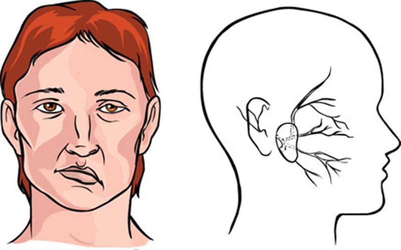  Bedanya Bell’s Palsy dan Ramsay Hunt Syndrome