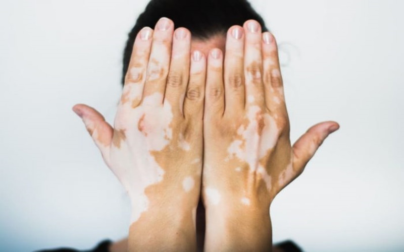 Kenali Penyebab dan Gejala Vitiligo yang Timbulkan Bercak Putih di Wajah dan Tubuh