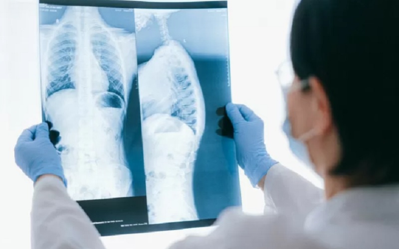 Ilustrasi dokter melihat hasil rontgenparu-paru./Antara