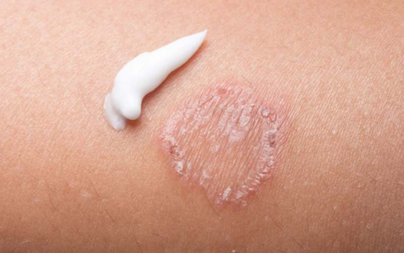  Ini 10 Cara Mengobati Penyakit Ringworm