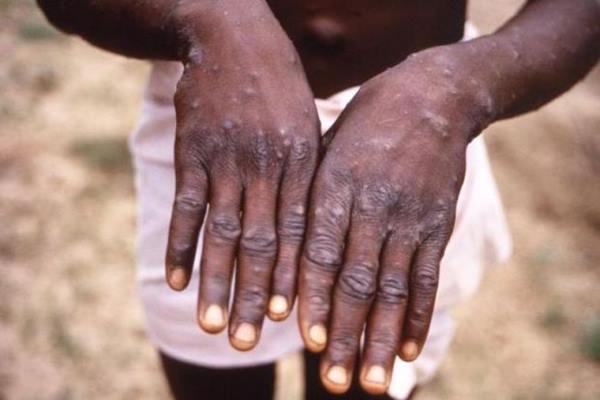  Temuan Baru, Singapura Catat 9 Kasus Positif Monkeypox Sejak Juni 2022