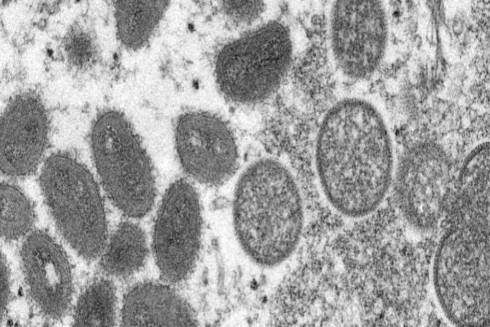  Waspada Pseudo-Pustula, Gejala Baru dari Penyakit Cacar Monyet