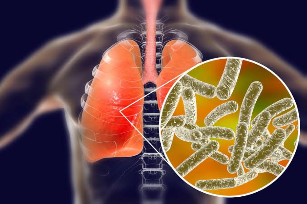  Gejala Pneumonia Misterius, Penyakit yang Disebabkan Bakteri Legionnaires