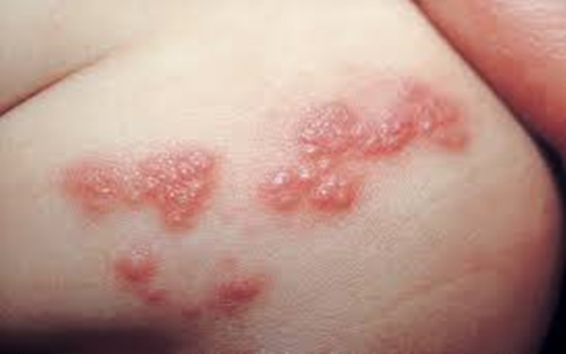  Waspada Beragam Penyakit Kulit Menular, dari Kurap hingga Herpes