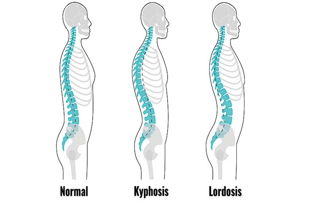  Perbedaan Kifosis dan Lordosis, dan Cara Mencegahnya