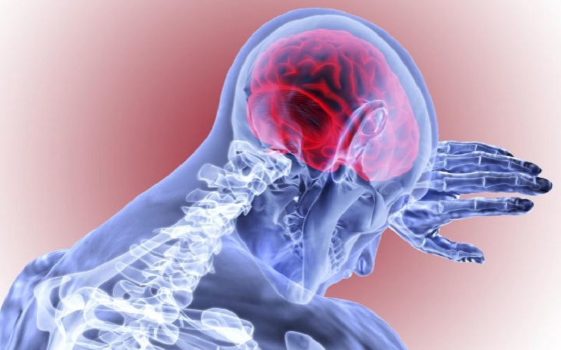  Gejala dan Penyebab Pendarahan Otak, Seperti yang Dialami Indra Bekti