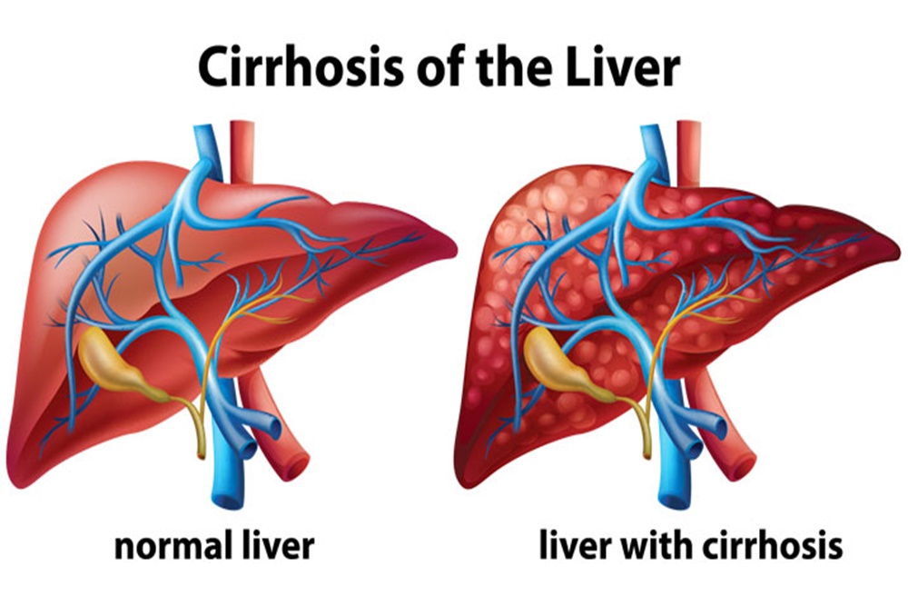  Kenali Gejala dan Tanda Penyakit Liver dari Kaki