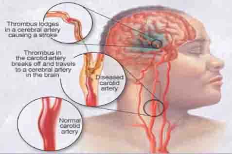 Ilustrasi sakit kepala karena stroke