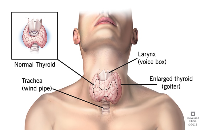 Ilustrasi tiroid/istimewa