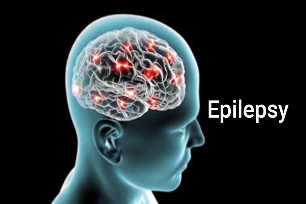  Paradigma baru Penanganan Komprehensif Kasus Epilepsi