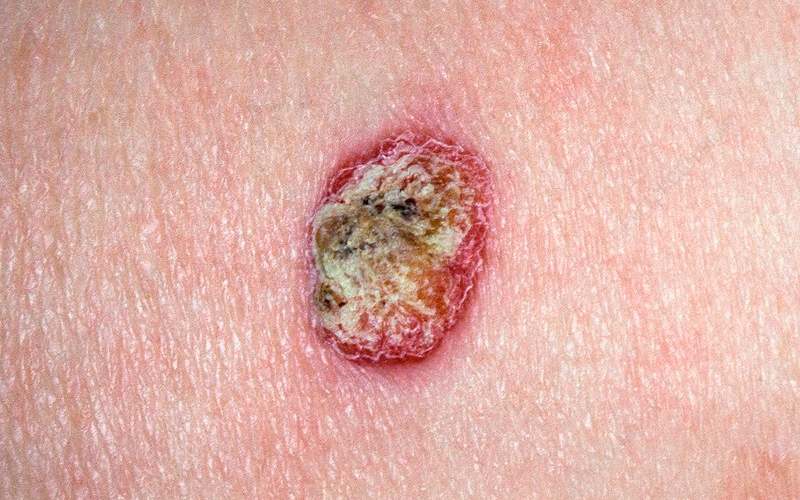  Melanoma, Kanker Kulit yang Paling Berbahaya