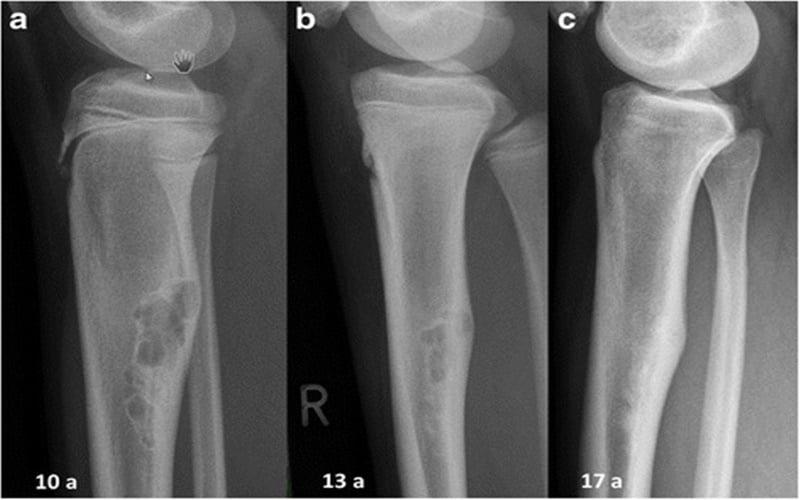  Gejala Osteosarcoma dan Sarkoma Ewing, Tumor Ganas pada Tulang