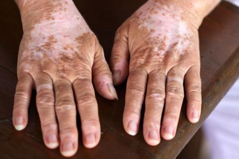  Viral Kena Vitiligo Karena Minum Suplemen, Bagaimana Faktanya?