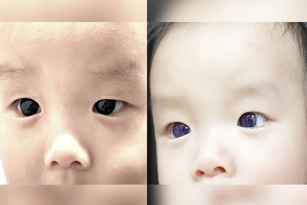 mata bayi berubah jadi biru