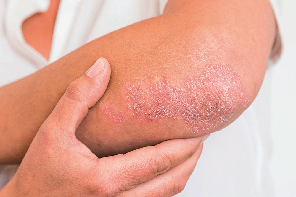  Psoriasis Tingkatkan Risiko Penyakit Jantung, Simak Ciri-cirinya