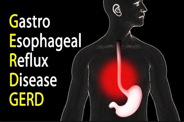  Punya Penyakit GERD, Stop Lakukan Ini
