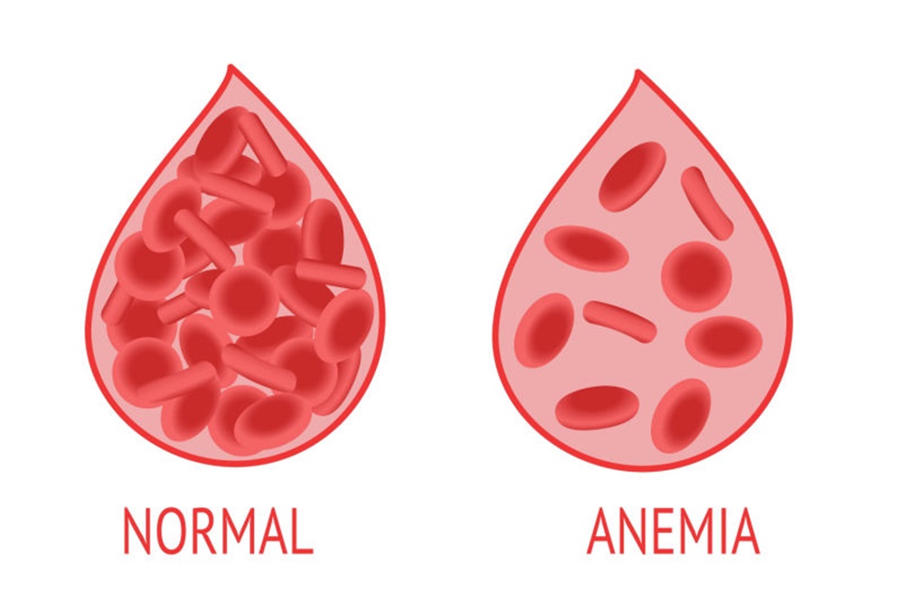 Anemia/emchospital