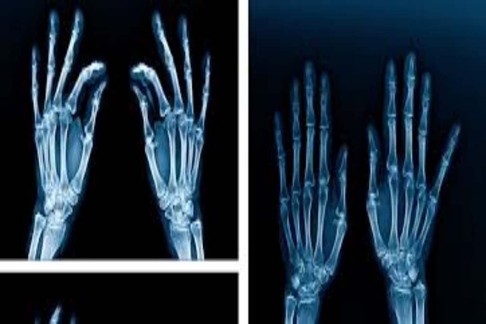  Siemens dan Hermina Group Kerja Sama dalam Inovasi Teknologi X-Ray