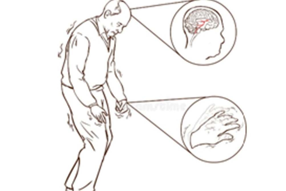  Tes Darah Teknologi AI Bisa Prediksi Gejala Penyakit Parkinson 7 tahun Sebelum Terjadi