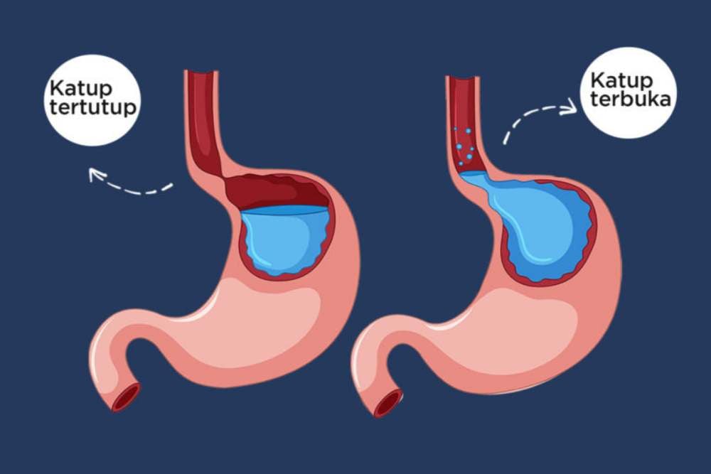  GERD Tak Kunjung Sembuh, Perlukah Laparaskopi?