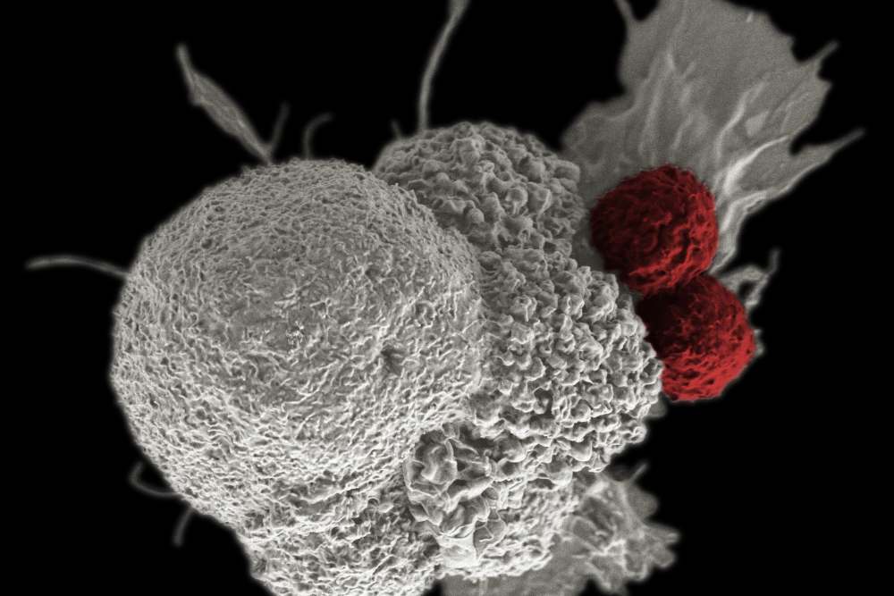  RSPP Tingkatkan Layanan Manajemen Kanker Payudara, Hematologi, Gagal Jantung