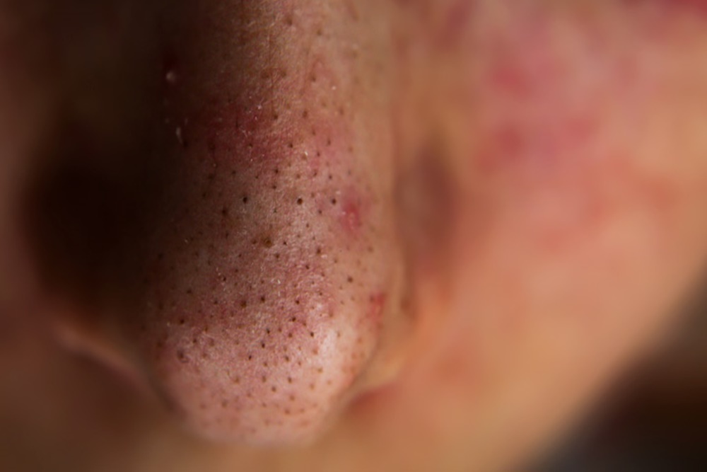  6 Kebiasaan yang Bisa Memicu Penyakit Telinga Hidung Tenggorokan atau THT