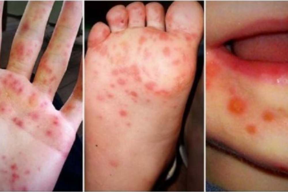  Kasus Meningkat, Kenali Gejala dan Cara Penanganan Flu Singapura pada Anak