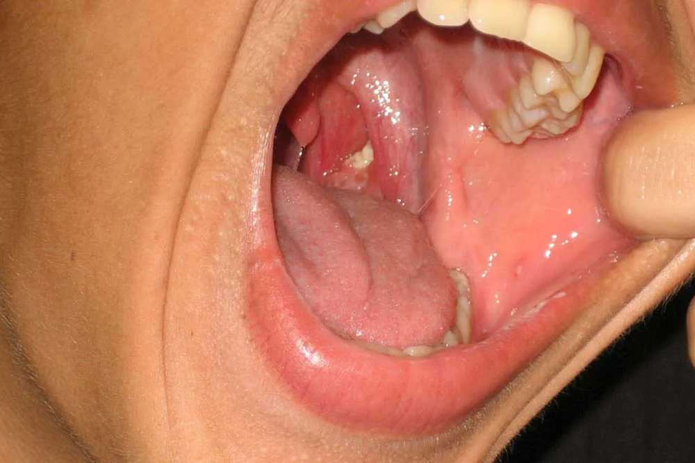 Batu amandel/Silver Dental