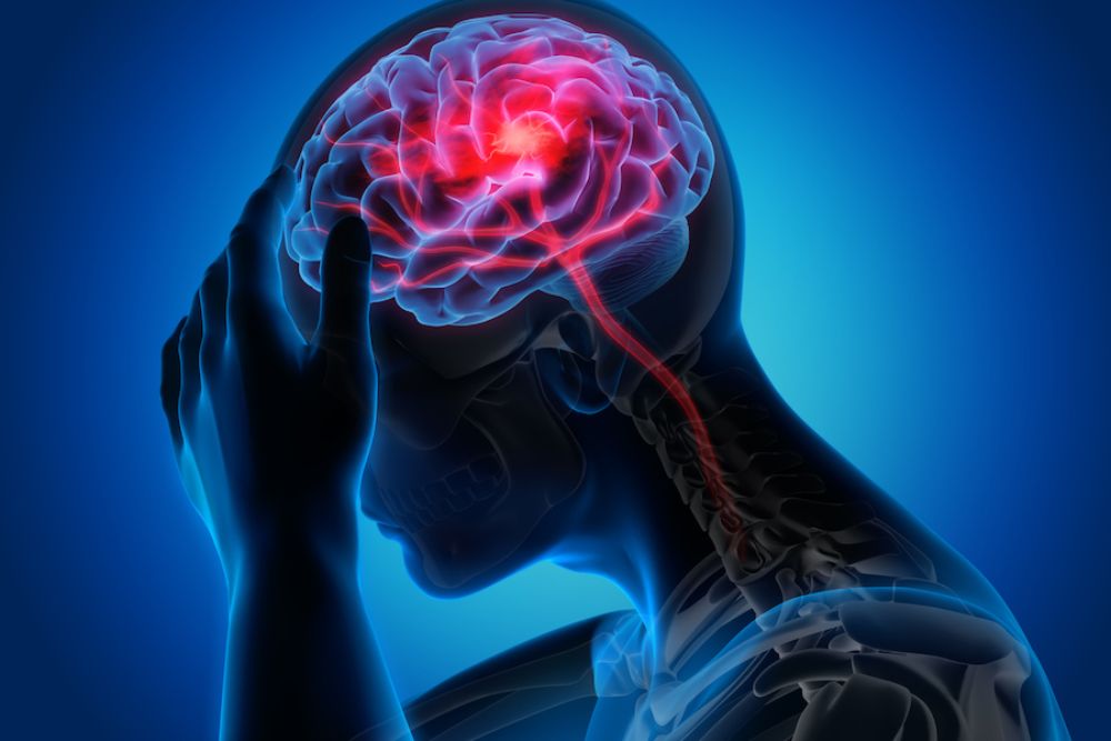  Penanganan Pasien Stroke dengan Sistem Code S