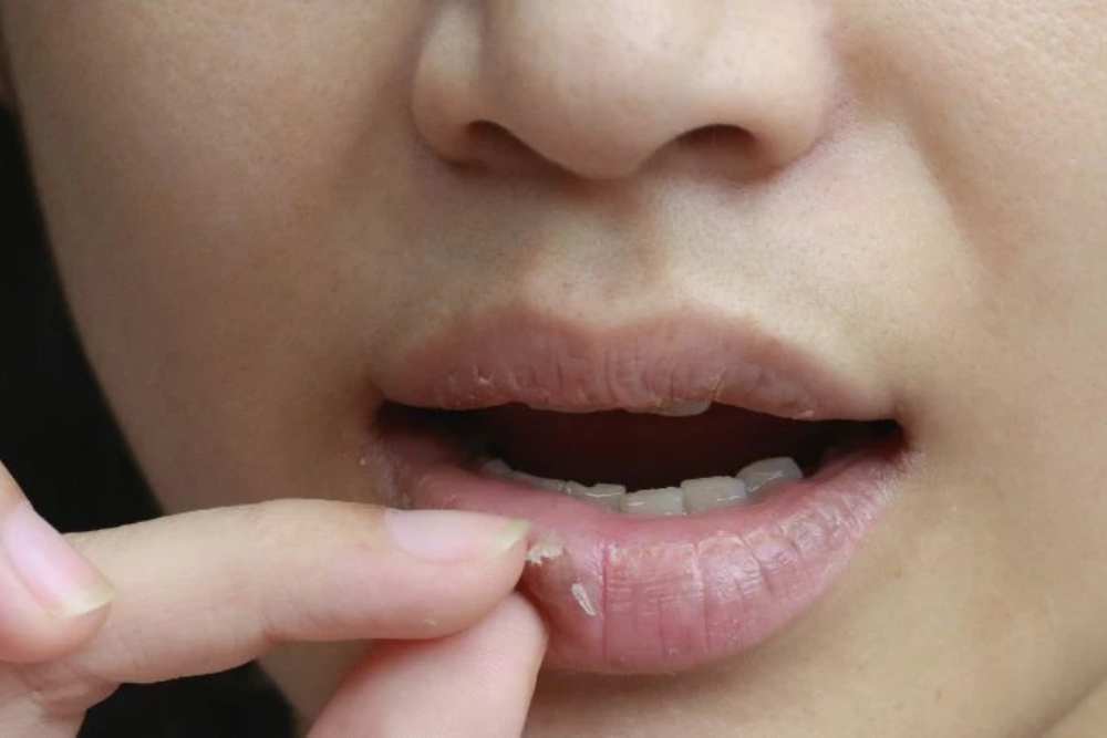  5 Penyebab Bibir Kering dan Gelap