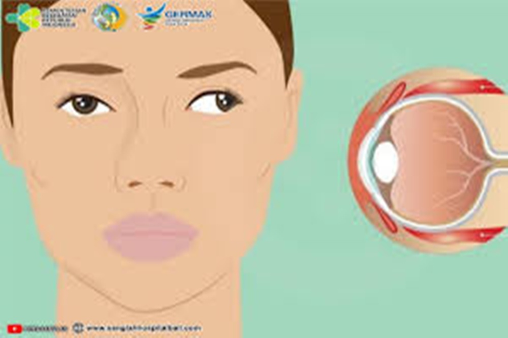 Ilustrasi mata juling/kemenkes