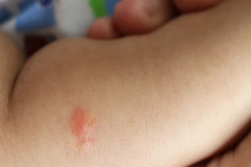  Kenali Gejala Penyakit Kusta dan Penyebabnya, Bisa Disembuhkan