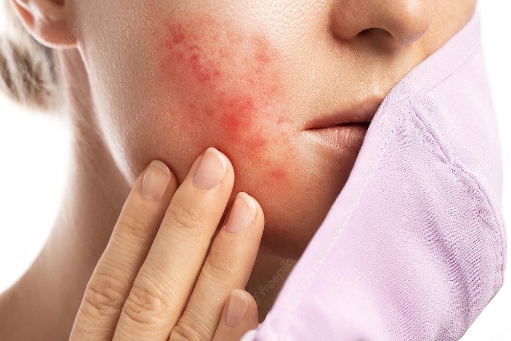  Perbedaan Jerawat dan Rosacea, Cara Menjaga Kesehatan Kulit Wajah
