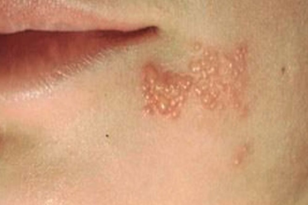 Vaksin Herpes Zooster Bisa Kurangi Risiko Sakit Jantung