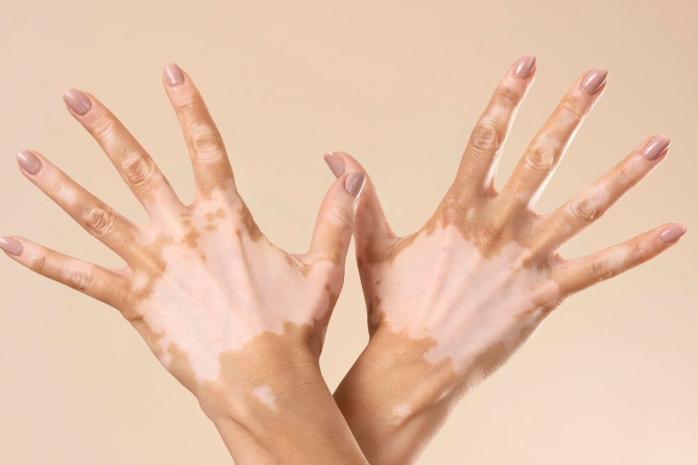  Neurofibromatosis Tipe 1, Penyakit Langka yang Tidak Bisa Diabaikan