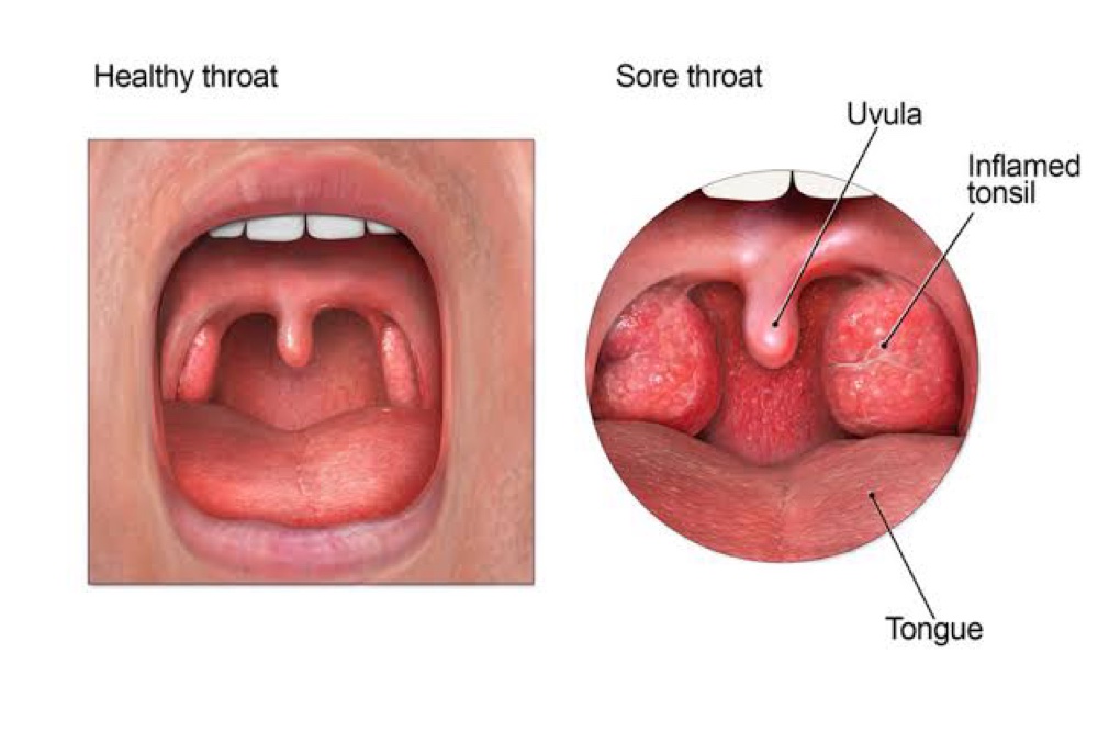  Mengenal Manfaat Gypsum Fibrosum dan Calcitum, Bisa Redakan Panas Dalam pada Anak