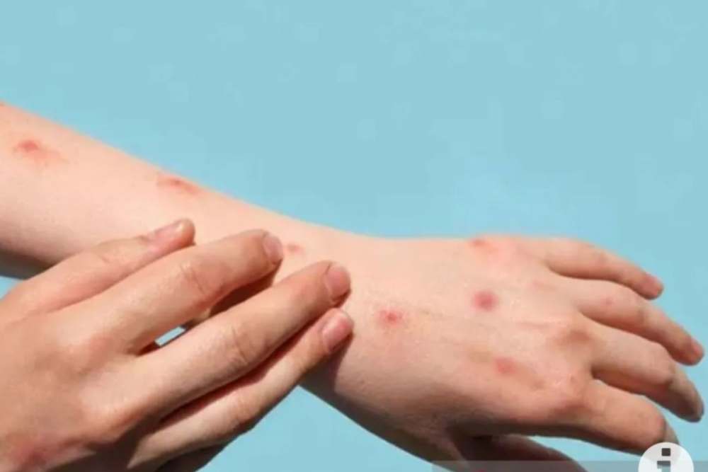  Awas Komplikasi Cacar Api, Bisa Sebabkan Risiko Penyakit Jantung dan Stroke