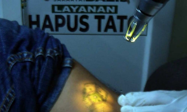 Layanan Hapus Tato Gratis Bagi Masyarakat di Jakarta