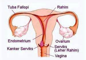 Ini Cara Deteksi Dini Kanker Serviks