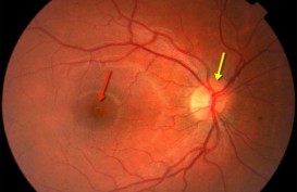 Degenerasi Makula: Catat, Cara Mencegah Penyakit Mata Lansia Ini