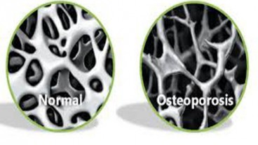 Bergerak Kurangi Risiko Osteoporosis