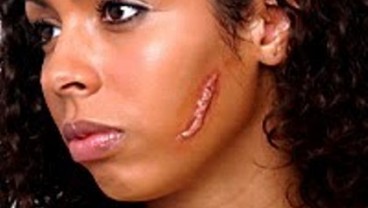 KELOID Bekas Luka Ganggu Kepercayaan Diri Anda? Simak Informasi Berikut