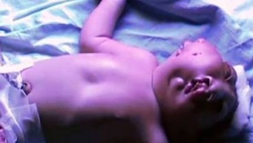 Bayi Bermuka Dua Lahir di India