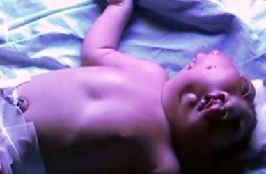 Bayi Bermuka Dua Lahir di India