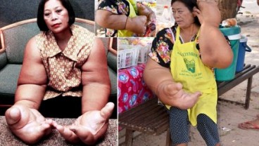 Wanita Ini Memiliki Tangan Seberat 10 KG