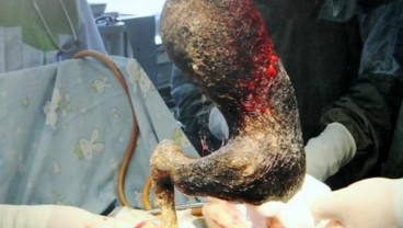 4 Kg Rambut Diangkat Dari Perut Gadis Ini