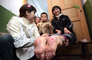 Wanita China Berkaki Terbalik Bisa Hidup Normal
