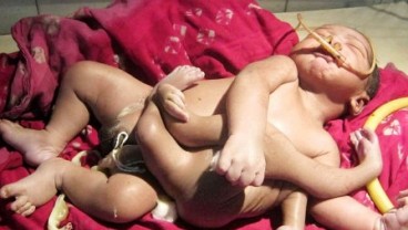 Bayi Lahir dengan Empat Lengan dan Kaki di India Dijuluki God Boy
