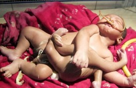 Bayi Lahir dengan Empat Lengan dan Kaki di India Dijuluki God Boy