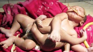 Berkaki Empat, Bayi Ini Dianggap Putra Dewa Brahma